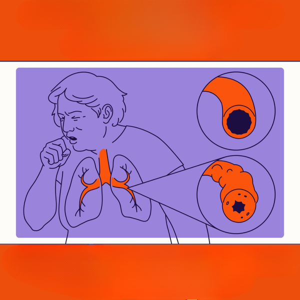 Bronchitis: Ursachen, Symptome und Behandlungsmöglichkeiten