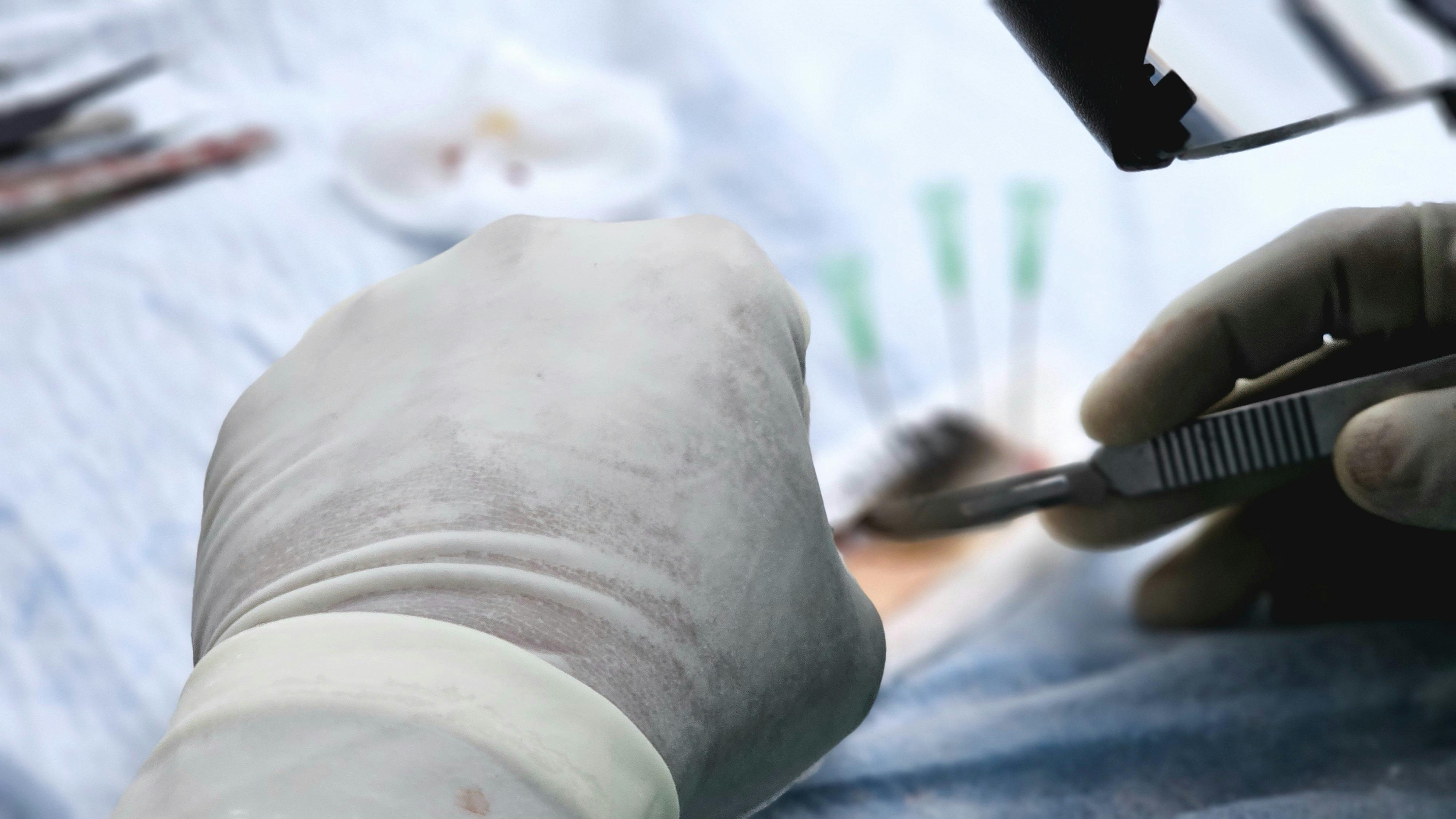 Unveiling the Truth: A Comprehensive Guide to Hair Transplantation