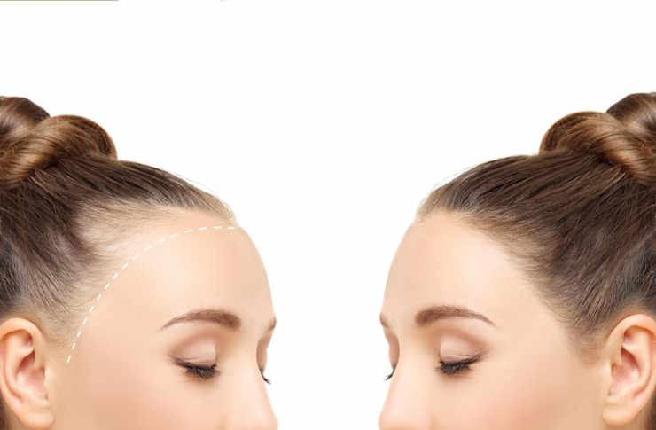 Trasplante de Cabello: Una Guía Completa sobre este Procedimiento Cosmético