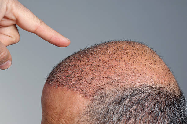 Understanding Hair Transplants: An In-Depth Look at What to Expect