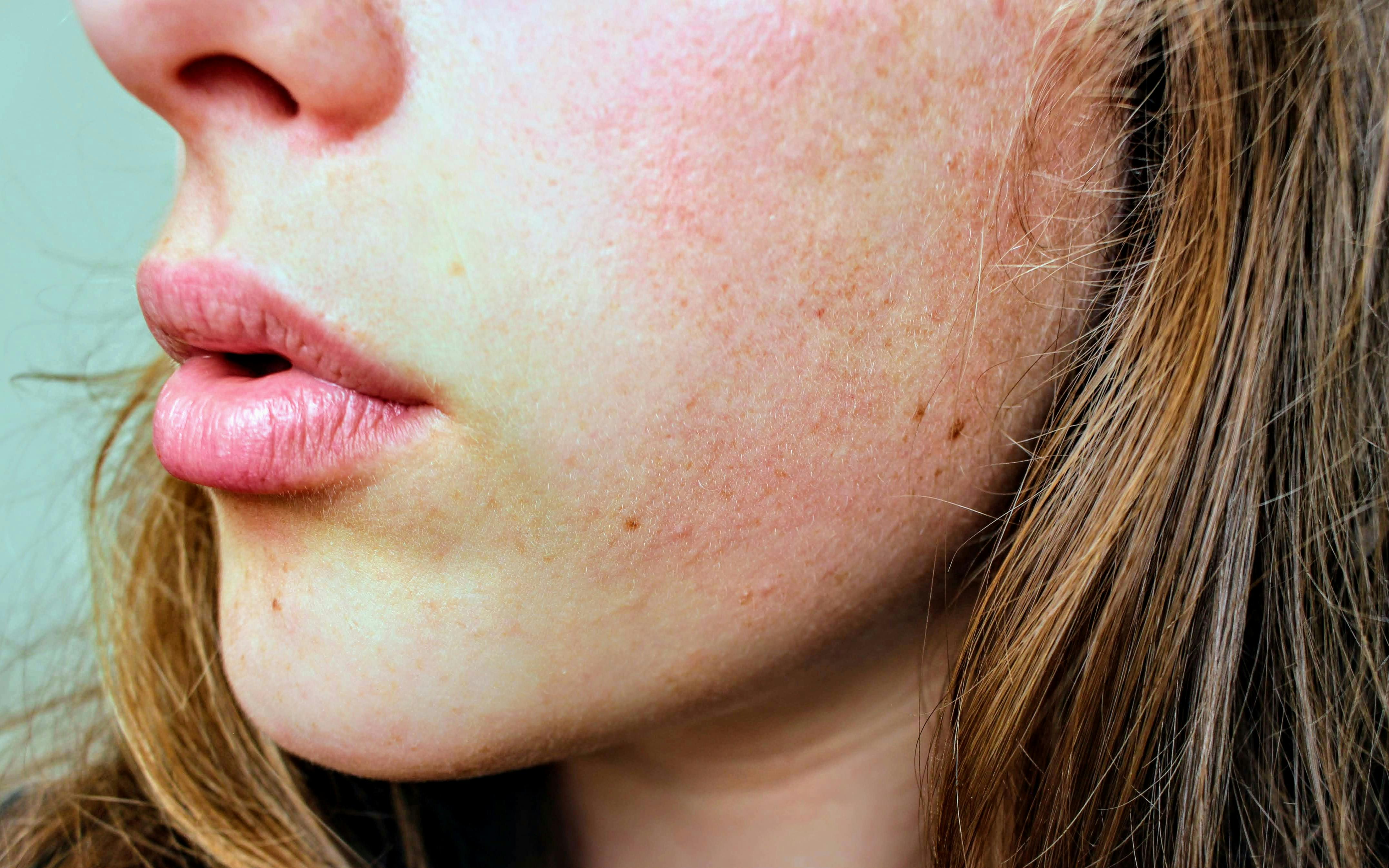 Understanding the Miracles and Misconceptions of Botox