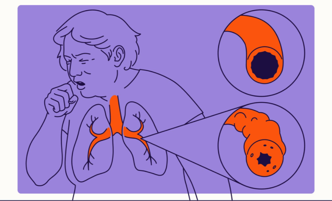 Myelodysplastic Syndrome: Hidden Body Signals That Point to Serious Issues