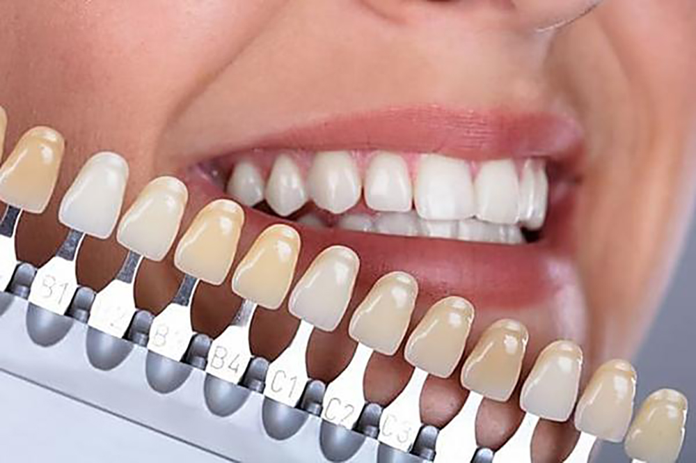 Implant Dentar în România: O Investiție în Sănătate și Încredere