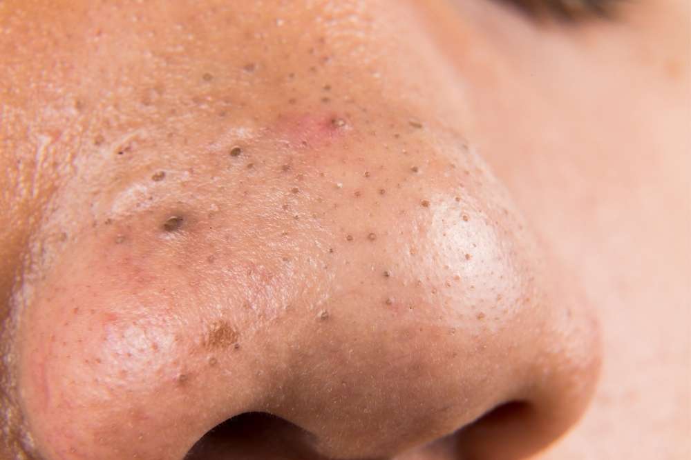 A Comprehensive Guide to Acne Treatment: From Home Care to Professional Solutions