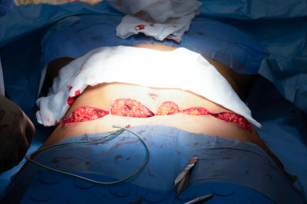 Decoding the Art of Tummy Tuck: A Comprehensive Guide to Abdominoplasty
