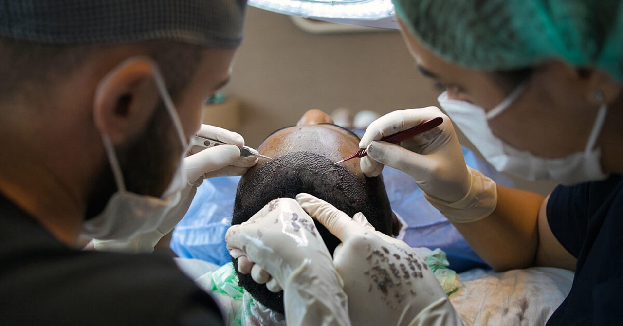 The Science and Success Behind Hair Transplants