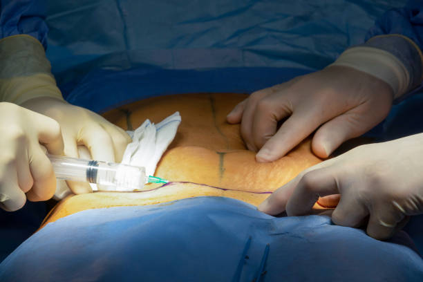 Understanding the Science and Aesthetics of Tummy Tuck Surgery
