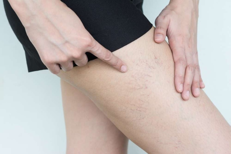 Varicose Vein Treatments in the USA for 2025