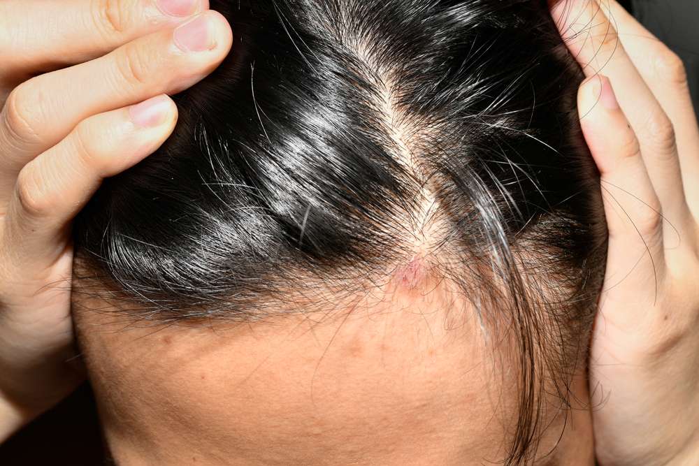 The Hidden World of Scalp Microbiome: A Hair Health Revolution