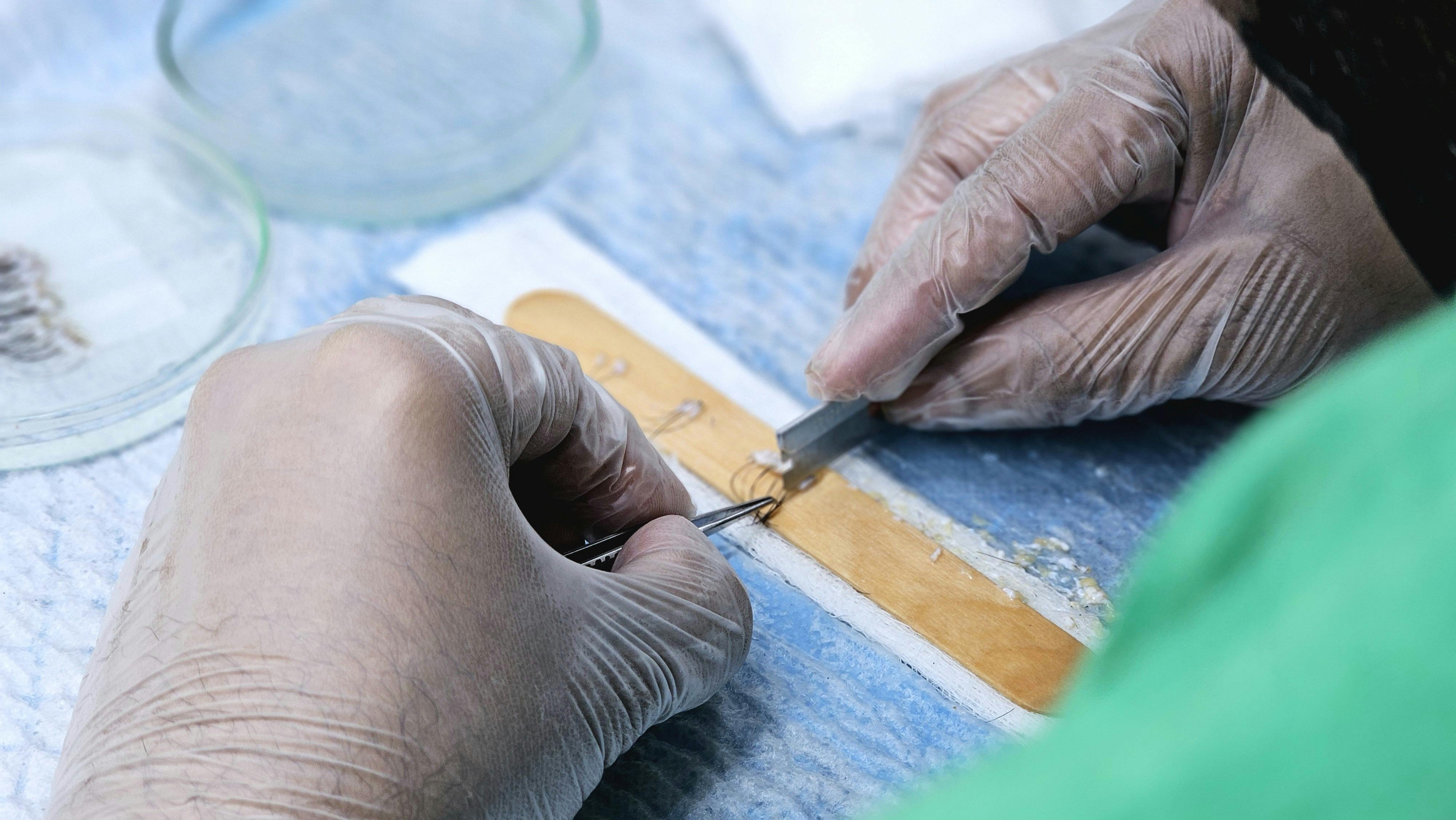Understanding the Science Behind Hair Transplants