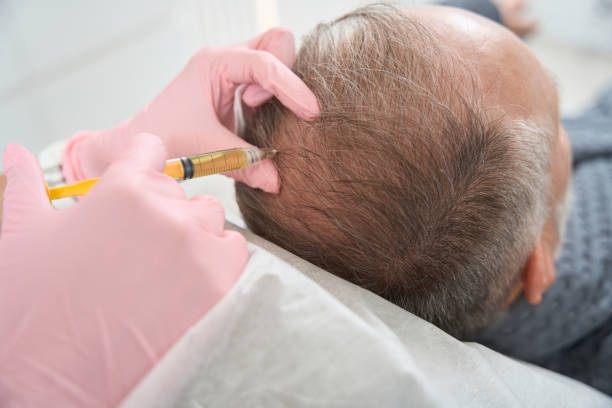 Demystifying Hair Transplants: A Comprehensive Guide to Restoring Your Tresses