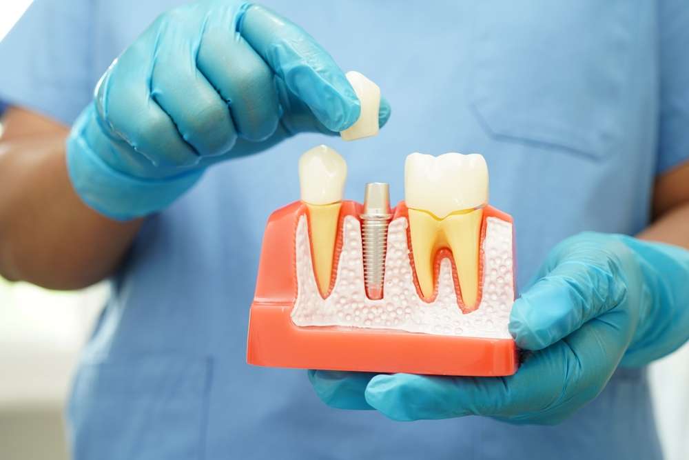 Tandheelkundige Implantaten voor Senioren: Voordelen, Procedures en Overwegingen